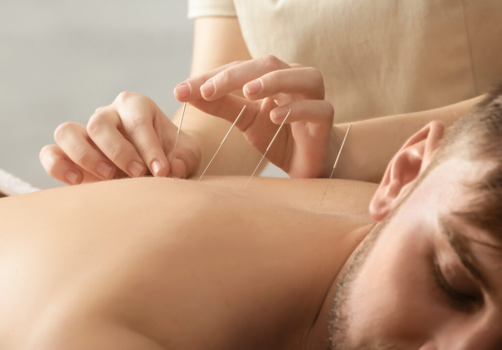 A photo of a man getting acupuncture treatment on his back.