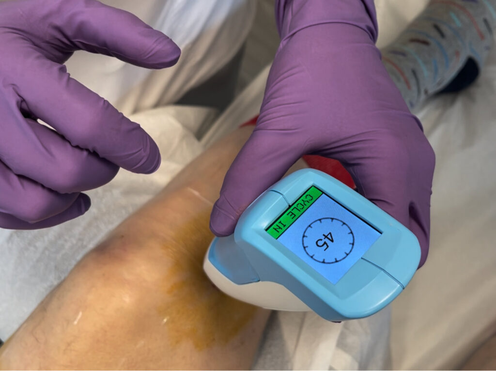 Freezing and ablating the nerve for pain relief